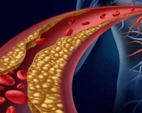 Rối loạn lipid máu: Nhận diện nguy cơ và giải pháp kiểm soát an toàn