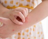Giải pháp thảo dược cho trẻ bị nổi mề đay