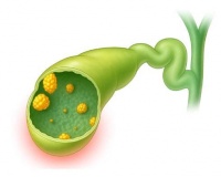Polyp túi mật 14mm có nguy hiểm không?