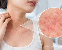 Phát ban do nhiệt: Nhận biết và xử lý thế nào?