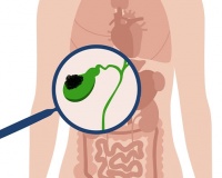 Đa polyp túi mật 9x8mm nên xử trí thế nào?