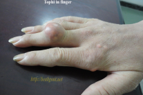 Bệnh gout ở người cao tuổi: Những biến chứng và cách hạn chế