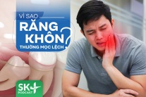 Podcast: Răng khôn mọc lệch phải làm sao?