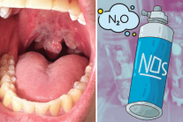 Cảnh báo nguy cơ bỏng lạnh khi lạm dụng khí N2O