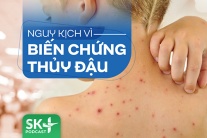 Podcast: Nguy kịch vì biến chứng thủy đậu