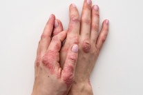 Vảy nến và nguy cơ viêm khớp: Những thông tin bạn cần biết