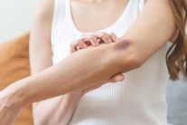 Đằng sau những vết bầm tím không rõ lý do 