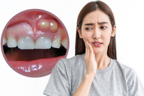 Bị viêm lợi có mủ liệu có tự khỏi được không?