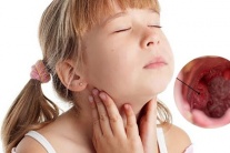 Biến chứng viêm amidan quá phát độ 4 ở trẻ em - Cha mẹ chớ chủ quan