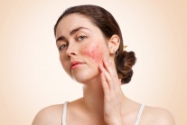 Lupus ban đỏ và ảnh hưởng đến sức khỏe toàn diện