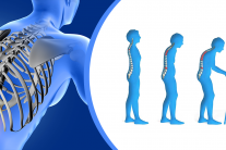 Loãng xương: Thủ phạm âm thầm gây tàn phế ở người cao tuổi