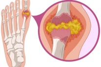 Nguy cơ từ các hạt tophi do bệnh gout