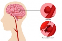 Dấu hiệu tiềm ẩn cảnh báo bệnh phình động mạch não