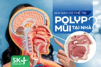 Podcast: Khi nào có thể trị polyp mũi tại nhà?