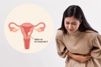Cách kiểm soát nhân xơ tử cung loại 2 để tránh biến chứng