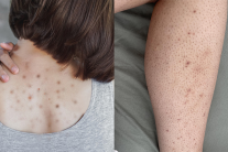 Giải pháp giúp làn da cơ thể mịn màng, hết mụn