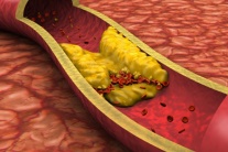 5 cách cải thiện mỡ máu cao hiệu quả