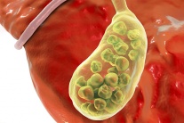 Có đám sỏi mật 27mm phải làm sao?