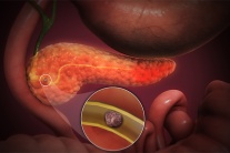 Có sỏi ống tụy 12mm cần xử trí thế nào để kiểm soát bệnh?