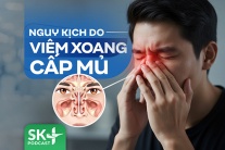 Podcast: Nguy kịch do viêm xoang cấp mủ