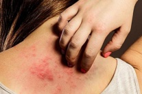 Vì sao bệnh vảy nến trở nặng khi trời lạnh?