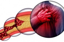 Mỡ máu cao - “thủ phạm” gây đột quỵ, nhồi máu cơ tim