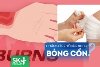 Podcast: Chăm sóc vết bỏng cồn thế nào để tránh nguy cơ nhiễm trùng?