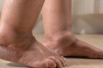 Sưng tấy bàn chân kéo dài cảnh báo dấu hiệu bệnh lý gì?