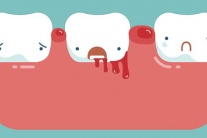 Cách cải thiện tình trạng chảy máu chân răng
