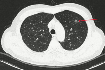 Đi khám sỏi thận, phát hiện ung thư phổi giai đoạn sớm nhờ AI
