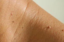 5 dấu hiệu cảnh báo bệnh đái tháo đường bạn không nên bỏ qua