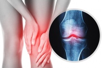 Đau xương khớp cảnh báo bệnh gì?