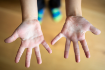 Cha mẹ cần cảnh giác với bệnh tay chân miệng ở trẻ