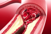 Hẹp mạch vành do vôi hóa khác gì do mảng bám cholesterol?