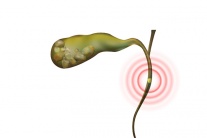 Có sỏi ống mật chủ 36x12mm: Dùng TPBVSK Kim Đởm Khang được không?