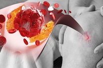 Yoga có giúp kiểm soát acid uric cao không?