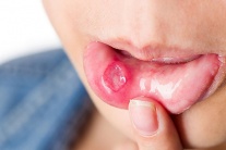 Dấu hiệu ở miệng chứng tỏ bạn thiếu vitamin B12