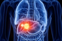 Sỏi đường mật trong gan có nguy hiểm không, nên xử trí thế nào?