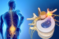7 nguyên nhân dẫn đến thoát vị đĩa đệm