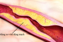 Yếu tố nguy cơ gây xơ vữa động mạch nên biết để phòng ngừa