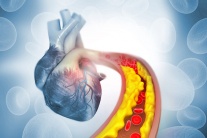 Tăng huyết áp kèm cholesterol cao: “Bộ đôi” đẩy nhanh xơ vữa mạch