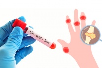 8 thói quen nhỏ giúp kiểm soát acid uric cao