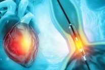 Hẹp mạch vành sau khi điều trị có tự hồi phục hoàn toàn không?