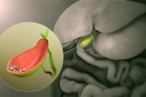 Tán sỏi qua da dễ tái phát phải làm sao?