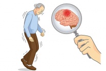 Bị run tay do thoái hóa chất trắng có dùng TPBVSK Vương Lão Kiện được không?