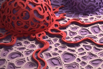 Biểu hiện của khối u ác tính như thế nào?