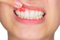 “Thủ phạm” gây viêm lợi và cách phòng ngừa thế nào?