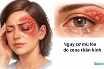 Nguy cơ mù lòa do zona thần kinh