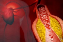 Xơ vữa động mạch - “Kẻ giết người thầm lặng” và giải pháp phòng ngừa hiệu quả