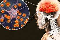 Bệnh viêm não mô cầu diễn biến phức tạp, Bộ Y tế cảnh báo